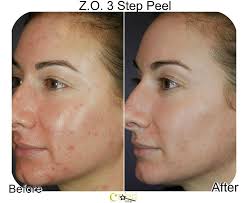 While many chemical peels are performed in a doctor's office, there are also home versions that use less potent chemicals. Chemical Peel At Home For Face Neck And Chest Charmed Medispa