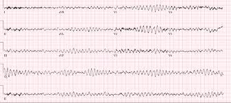 Emdocs Net Emergency Medicine Educationlvad Patients What You Need To Know Emdocs Net Emergency Medicine Education