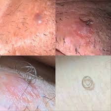 Three of the most common reasons why ingrown. Never Ending Ingrown Hair Plucking