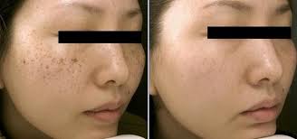 Apabila anda ingin menghilangkan bintik hitam pada wajah, cobalah mengoleskan selapis tipis pengisi jaringan parut dengan cara seperti ketika anda menggunakan riasan. Cara Menghilangkan Flek Bintik Hitam Pada Wajah Secara Alami Analisa 6