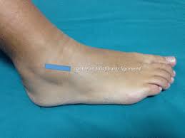 Anterior drawer test is performed to test the integrity of the anterior cruciate ligament of the knee. Epos