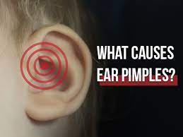 The ear pimples, otherwise called as ear zits or ear bumps, are medically called as sebaceous cysts (1). What Causes Ear Pimples And How To Treat It Boldsky Com