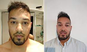 Additionally, men who wear helmet experience major hair loss in summer because sweat accumulates in the pores and weakens hair roots causing hair loss. Myths And Truths About Hair Loss What You Should To To Prevent Balding Express Co Uk