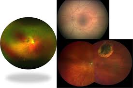 This combined device facilitates the early detection, management and effective treatment of disorders and diseases evidenced in the retina such as retinal detachments and tears, glaucoma, diabetic retinopathy. Widefield Imaging Of Retinal And Choroidal Tumors International Journal Of Retina And Vitreous Full Text