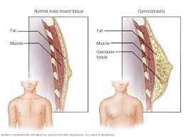 Men can test for a cancerous lump using these eight steps. Enlarged Breasts In Men Gynecomastia Symptoms And Causes Mayo Clinic