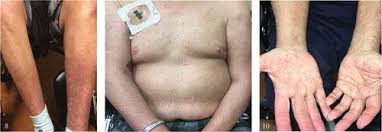 Image result for scabies norvegica