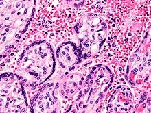 Η ελονοσία είναι λοιμώδης ασθένεια που προκαλείται από πρωτόζωα του γένους πλασμώδιο που παρασιτούν στα for faster navigation, this iframe is preloading the wikiwand page for ελονοσία. Elonosia Bikipaideia