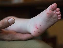 It is caused by a group of viruses called enteroviruses, most commonly, the coxsackievirus a16. Hand Foot And Mouth Disease In Kids Symptoms Treatment Prevention