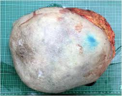 We analyzed a group of . A Giant Malignant Phyllodes Tumor Of Breast Post Mastectomy With Metastasis To Stomach Manifesting As Anemia A Case Report And Review Of Literature Bmc Surgery Full Text