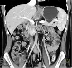 Fap is a new target molecule for pet imaging of various tumors. Pancreatic Cancer Encases The Celiac Axis And Pv Smv With Liver Metastases Pancreas Case Studies Ctisus Ct Scanning