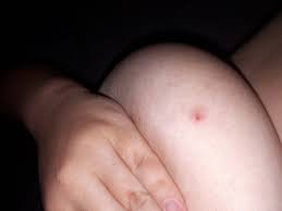 Inflammatory breast cancer is an uncommon but aggressive form of breast cancer, and many women don't recognize the warning signs. I Have This Rash On My Left Breast For A Month I Don T Know Why It S Not Healing Breast Cancer And Screening Forums Patient