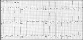 Image result for Left Ventricular Hypertrophy