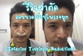 รีวิว ผ่าตัดลดขนาดเยื่อบุโพรงจมูก | Inferior Turbinate Reduction - Third  Nuntawat