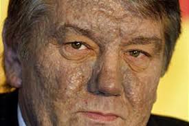 .a hallmark of dioxin poisoning. Yushchenko Alleges Political Murder Deseret News