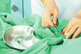 Image result for Urethral Catheterization