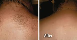 See more ideas about back hair removal, unwanted hair removal, hair removal. Before And After Gallery City Dermatology And Laser