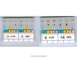 Jun 15, 2021 · licensed biological products with supporting documents is arranged alphabetically by the proper name of the product(s). Blood Grouping Slide Tube Methods Ppt Video Online Download