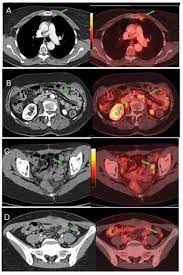 Learn about the signs and symptoms of ovarian cancer such as bloating, pelvic or abdominal (belly) pain, feeling full quickly, and urinary symptoms. Staging Recurrent Ovarian Cancer With 18fdg Pet Ct