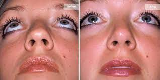 De multe ori ne gandim ca pretul pentru o operatie de rinoplastie este destul de mare. Rinoplastie Pret Operatie Estetica La Nas Cosmedica