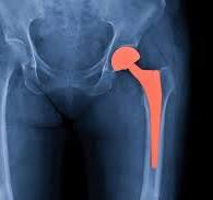Descompressão da cabeça femoral: saiba mais