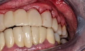 Image result for Periodontal Abscess