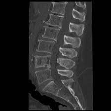 Radiographs revealed a picture frame l1 vertebra which was deformed and enlarged with loss of normal alignment. Vertebral Paget Disease With Picture Frame Appearance Radiology Case Radiopaedia Org