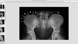 Image result for Risser Sign