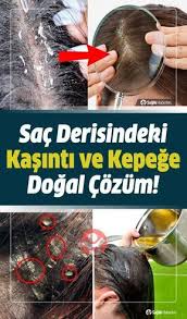 Sac Derisinde Kizariklik Ve Kasintisi Neden Olur Ne Iyi Gelir Nasil Gecer Sac Bakimi Dogal Sac Bakimi Sac Sac Dokulme Tedavileri