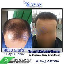 antalya sac ekimi ince saclar sac doktorlar