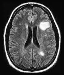Widespread use of mri (magnetic resonance imaging) has revolutionized the ability to diagnose multiple sclerosis. Multiple Sclerosis Practice Essentials Background Pathophysiology