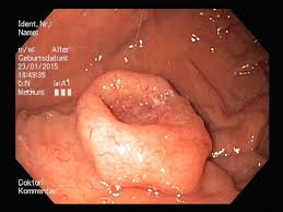 Wie sieht das blut aus? Gastroenterologie Krankheitsbilder Praxis Fur Innere Medizin In Walldorf