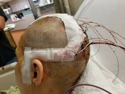 Epilepsy Brain Surgery Brain Surgery Epilepsy Surgery Temporal Lobe Epilepsy