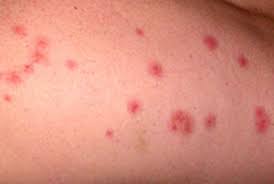 Check spelling or type a new query. How To Tell If I Have Bed Bugs Baltimore Bed Bug Exterminator