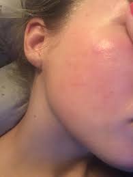 Utslett i ansiktet fungoral i ansiktet | agl.niwom.se. Rod Brennende Og Torr Hud I Ansiktet Kropp Og Helse Kvinneguiden Forum