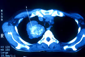 A cough associated with a cold or respiratory infection will go away in. Lung Cancer Pictures X Rays Of Tumors Screening Symptoms And More