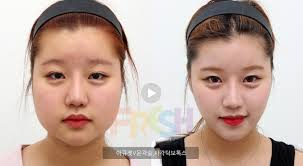 Improved symmetry may also make your nose appear smaller. Accuzet V Contouring Jaw Botox Korean Plastic Surgery Brazilian Butt Lift Fresh Plastic Surgery