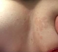 It is usually red or dark and may be itchy and sometimes smelly. Dry Skin Patches On Breast Atopic Dermatitis Symptoms