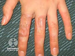 Image result for Photodermatitis