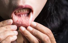 The first sign of melanoma is typically a new spot on the skin what do cancer lumps look like? What Does Lip Cancer Look Like Cancerwalls