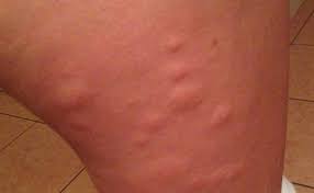 How to catch sand fleas (without a sand flea rake) sand fleas make great baits for pompano, sheepshead, redfish, and black drum. 11 Effective Home Remedies To Get Rid Of Sand Fleas Infestation