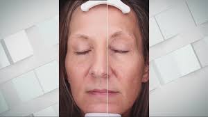 Creating youthful look