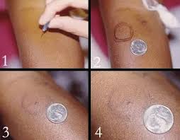 Image result for Pathergy