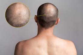 So, if you notice that your hair is thinning and you are over 40, know that you are not alone; Crown Hair Transplant Can It Be Restored To Look Natural Elithair