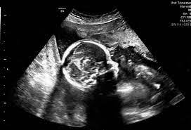 We did not find results for: Bleeding In Pregnancy A Story Of Uncertainty This Inspired Life