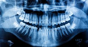 Although many jaw growths are benign, they can still do plenty of harm. Oral Cancer Screening Bremerton Wa Pacific Ave Dental
