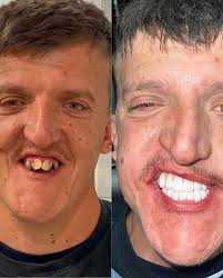 dentalimplants #pterygoidimplant #pterygoidimplants #dentaleducation  #zygoma #zygomaticimplants #zygomaticimplant #zygomatic_implants #allon4  #allonfour #hybriddentures #hybriddenture…