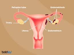 Excessive menstrual cramps, abnormal or heavy menstrual flow and pain during intercourse. Endometriosis Causes Symptoms Diagnosis Treatment Boldsky Com