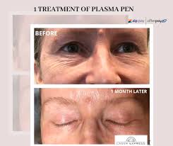 Wrinkles, smoker's lines and crow's feet can creep up