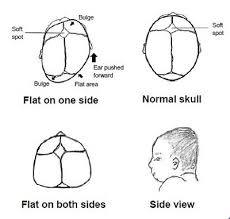 Image result for Positional Head Deformity