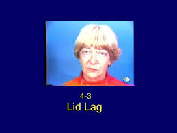Lid lag is the static situation in which the upper eyelid is higher than normal with the globe in lid lag differs from von graefe's sign in that the latter is a dynamic process. Lid Lag